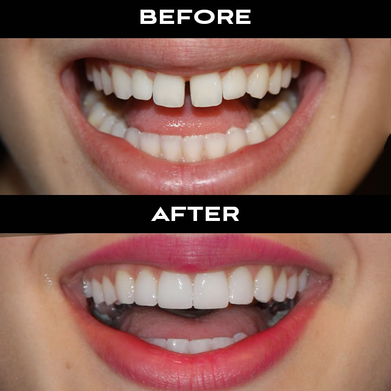 before after veneers
